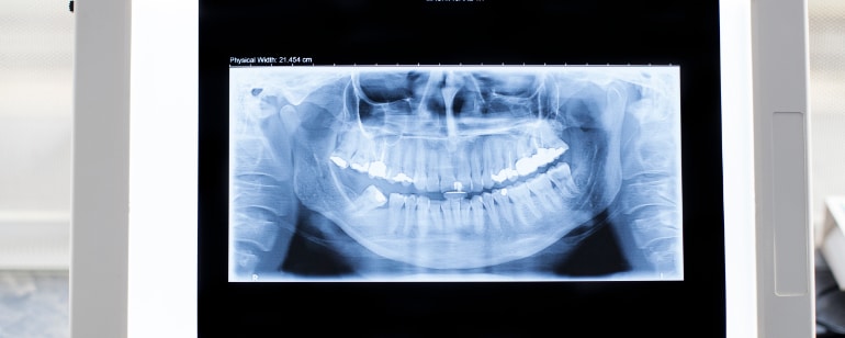 Лечение скрежета зубов по ночам Физиотерапевтическая практика Берлин Митте Кристиан Марш